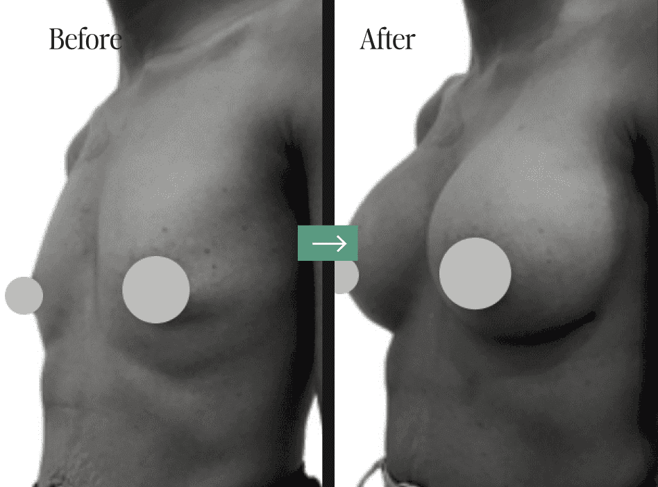 Breast Implant Removal Before and After Pictures Charleston, SC